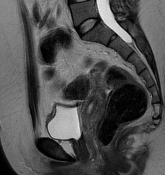 File:Broad ligament leiomyoma (Radiopaedia 81634-95516 Sagittal T2 15).jpg