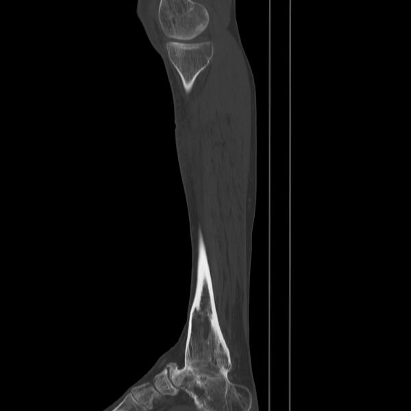 File:Brodie abscess - tibia (Radiopaedia 66028-75204 Sagittal bone window 14).jpg