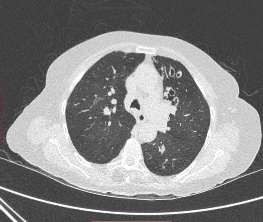 Bronchiectasis (Radiopaedia 72693-83293 Axial lung window 46).jpg