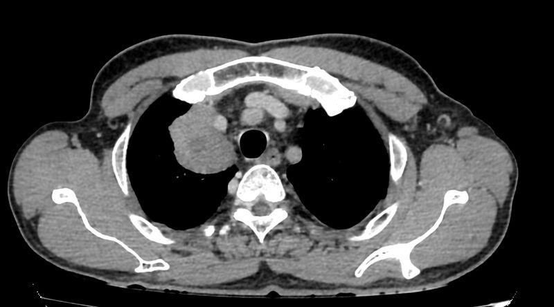 File:Bronchogenic carcinoma with superior vena cava syndrome (Radiopaedia 36497-38054 Axial C+ delayed 14).jpg