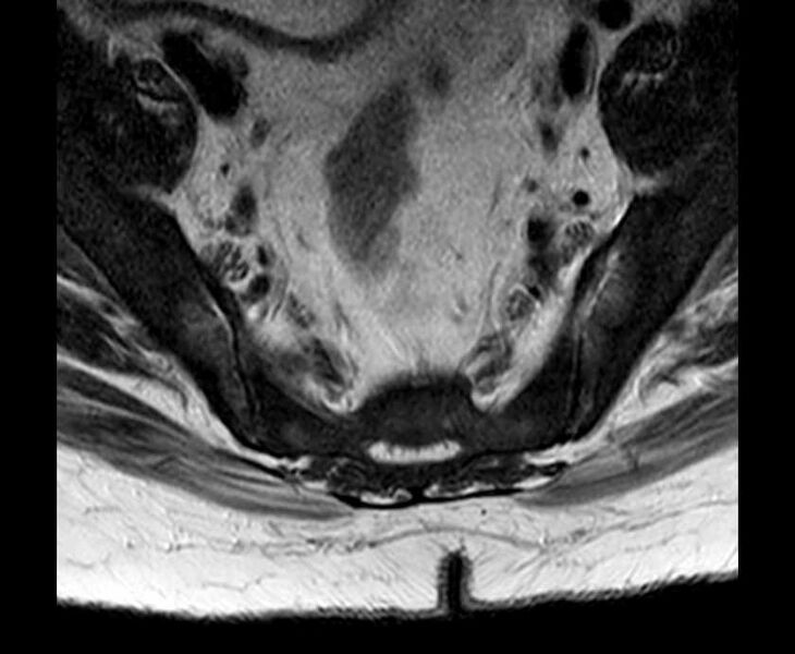 File:Brown tumors compressing the spinal cord (Radiopaedia 68442-78030 Axial T2 - lumbar 6).jpg
