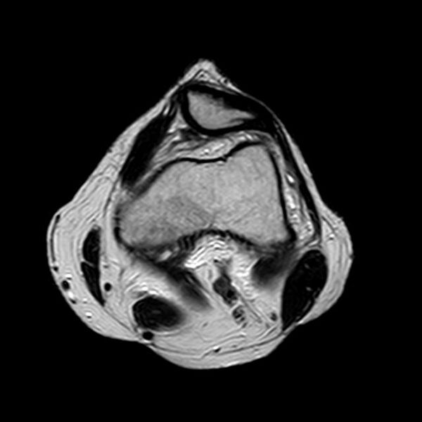 File:Bucket handle tear - medial meniscus (Radiopaedia 29250-29664 Axial T2 14).jpg