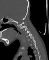 Butterfly vertebra (Radiopaedia 77903-90209 Sagittal bone window 19).jpg