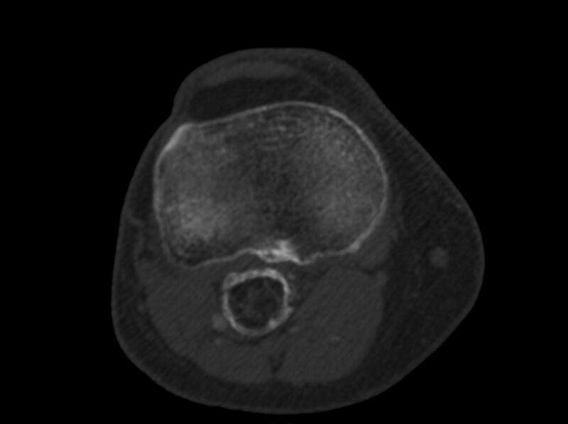 File:Calcified hematoma - popliteal fossa (Radiopaedia 63938-72763 C 43).jpg