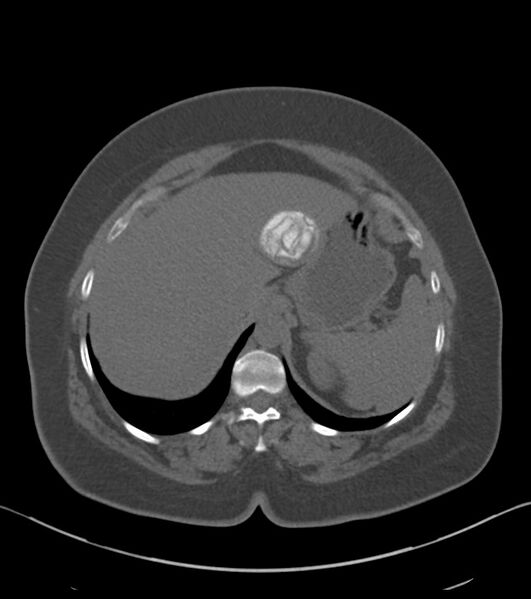 File:Calcified hepatic hydatid cyst (Radiopaedia 81127-94738 Axial non-contrast 20).jpg