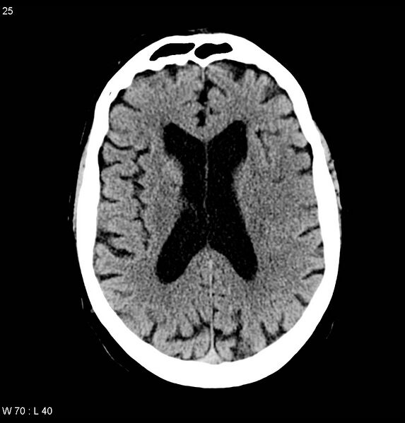 File:Calcified left middle cerebral artery embolism (Radiopaedia 5570-22120 Axial non-contrast 7).jpg