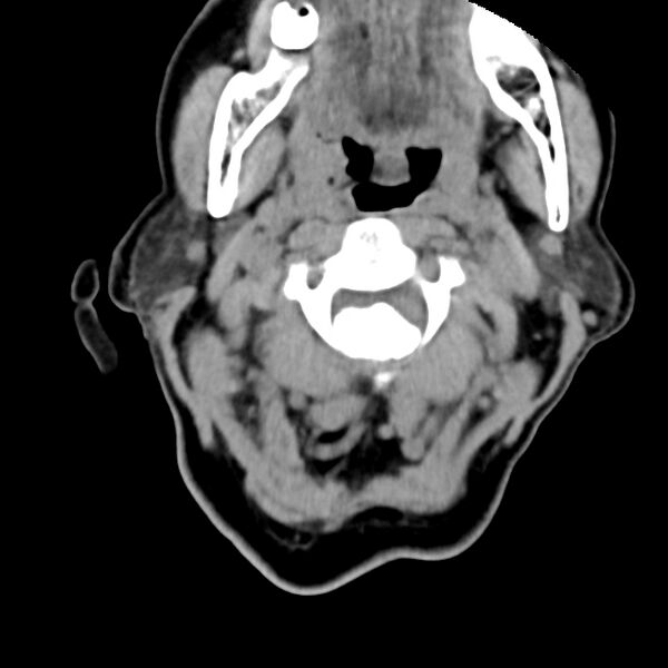 File:Calcified meningioma - cervical canal (Radiopaedia 70136-80171 B 9).jpg