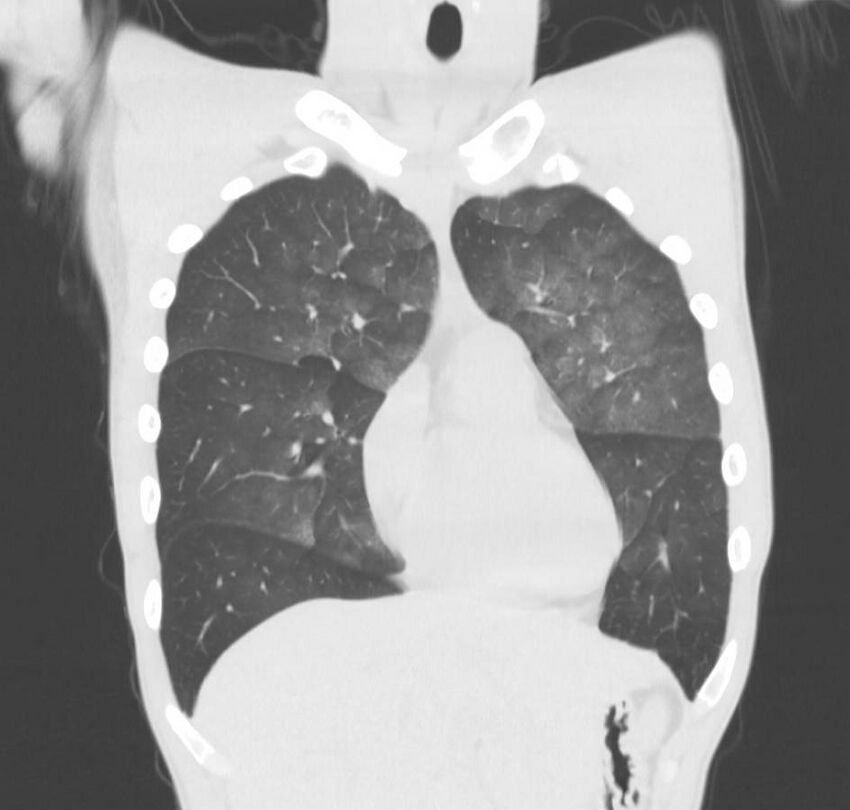 Cannabis-induced diffuse alveolar hemorrhage (Radiopaedia 89834-106946 Coronal lung window 65).jpg