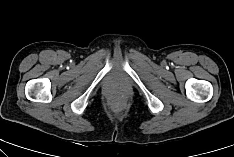 File:Carcinoid mesenteric tumor complicated by chylous ascites (Radiopaedia 76312-88926 A 84).jpg