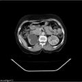 Carcinoma cervix- recurrence (Radiopaedia 34702-36137 B 18).jpg