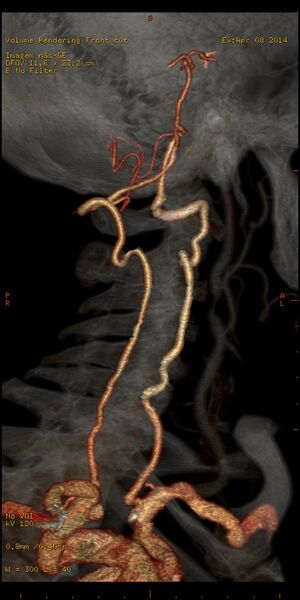 File:Carotid artery stenosis (Radiopaedia 28786-29086 B 12).jpg