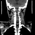 Carotid body tumor (Radiopaedia 27890-28124 B 2).jpg