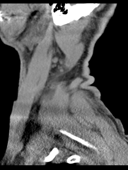 File:Cavernoma of cervical cord (Radiopaedia 50838-56346 B 76).png