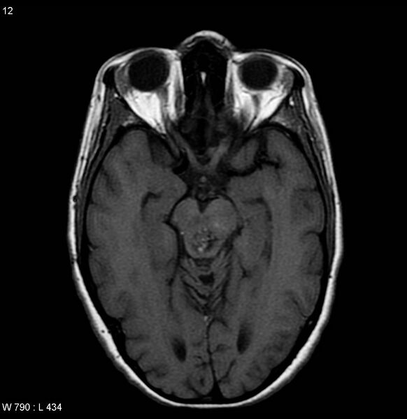 File:Cavernous malformation of the midbrain (Radiopaedia 7791-8615 Axial T1 1).jpg