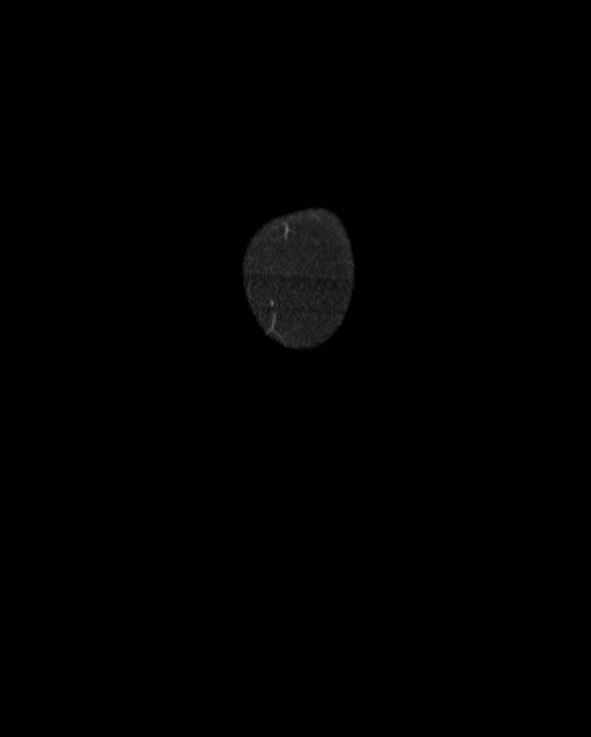 Cecal volvulus (Radiopaedia 54998-61310 B 1).jpg