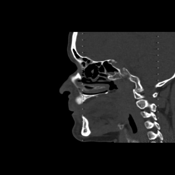 File:Cemento-ossifying fibroma (Radiopaedia 21243-21149 Sagittal bone window 4).jpg