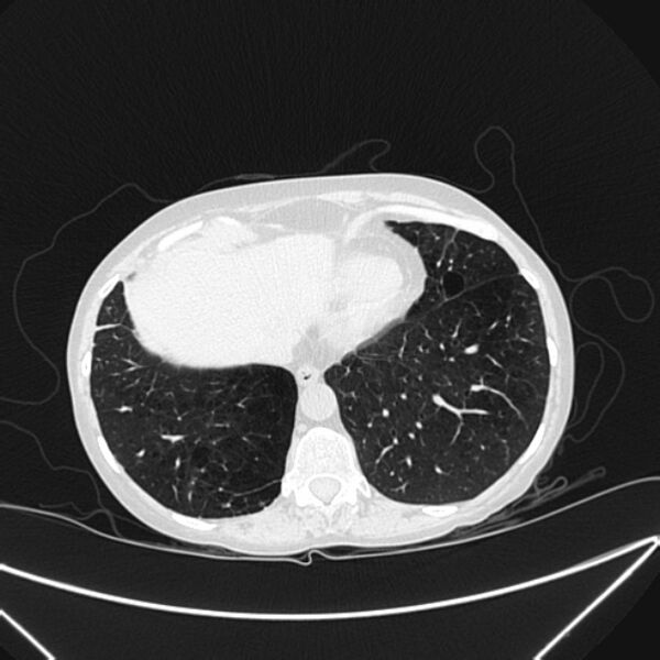 File:Centrilobular pulmonary emphysema (Radiopaedia 24495-24789 Axial lung window 76).jpg