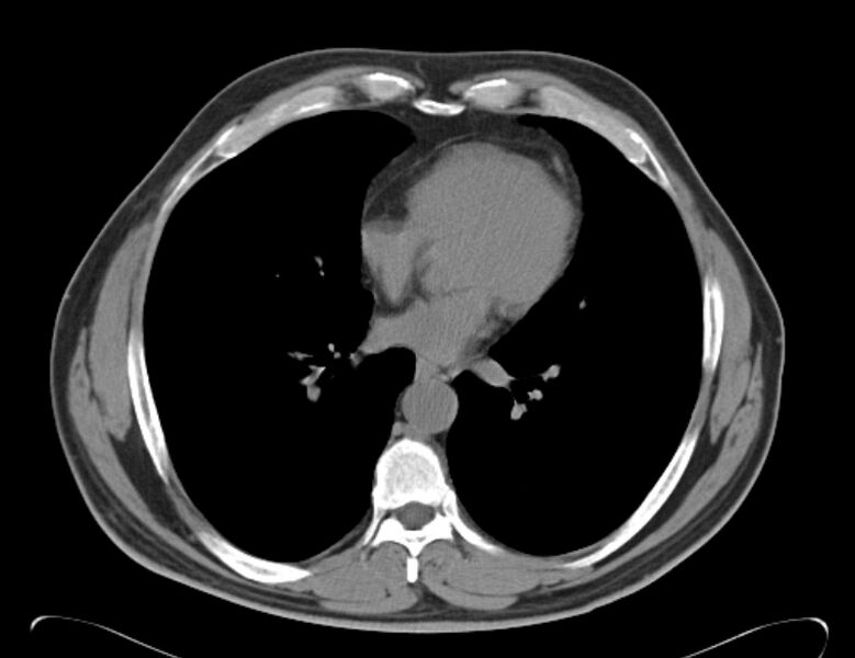 File:Centrilobular pulmonary emphysema (Radiopaedia 26808-26971 Axial non-contrast 27).jpg