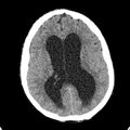 Cerebellar abscess secondary to mastoiditis (Radiopaedia 26284-26412 Axial non-contrast 92).jpg
