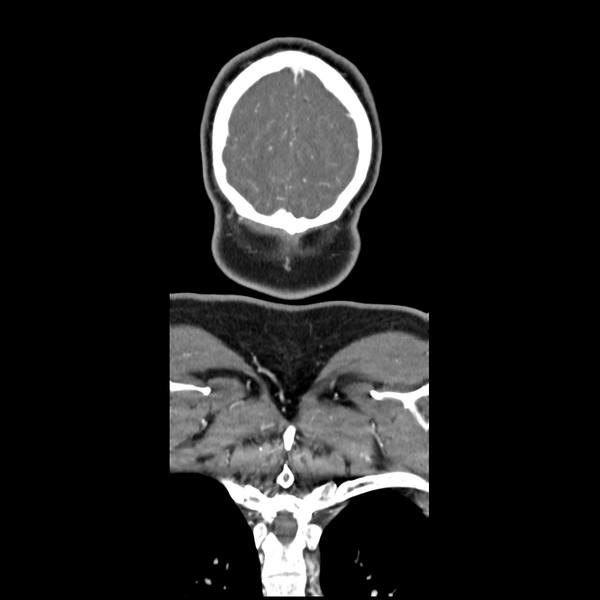 File:Cerebellar infarct due to vertebral artery dissection with posterior fossa decompression (Radiopaedia 82779-97029 D 60).png