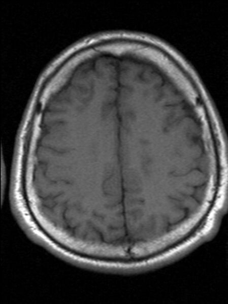 File:Cerebellopontine angle meningioma (Radiopaedia 24459-24764 Axial T1 18).jpg