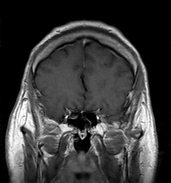 File:Cerebellopontine angle meningioma (Radiopaedia 24459-24764 Coronal T1 C+ 5).jpg