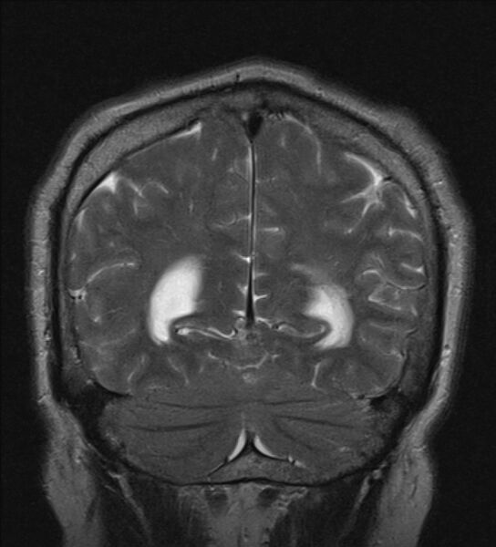 File:Cerebellopontine angle meningioma (Radiopaedia 24459-24764 Coronal T2 20).jpg