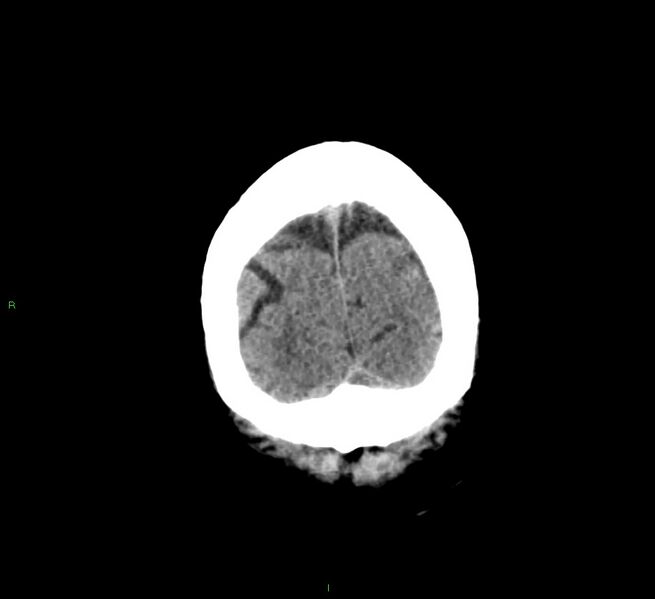 File:Cerebral amyloid angiopathy-associated lobar intracerebral hemorrhage (Radiopaedia 58376-65511 Coronal non-contrast 9).jpg