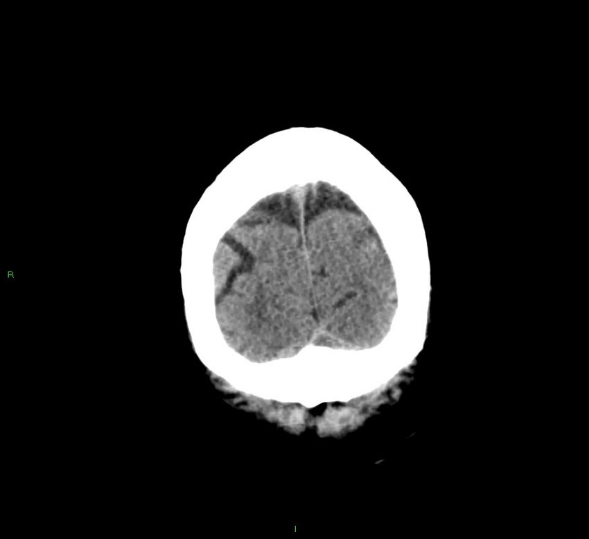Cerebral amyloid angiopathy-associated lobar intracerebral hemorrhage (Radiopaedia 58376-65511 Coronal non-contrast 9).jpg