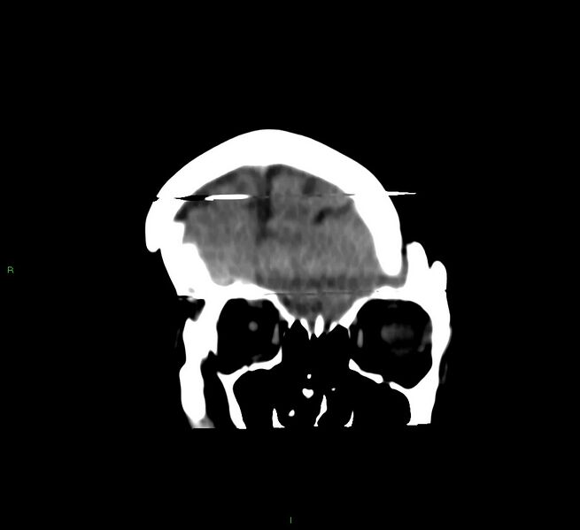 File:Cerebral amyloid angiopathy-associated lobar intracerebral hemorrhage (Radiopaedia 58377-65514 Coronal non-contrast 54).jpg