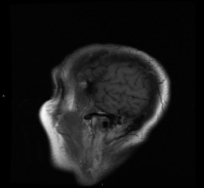 File:Cerebral amyloid angiopathy-associated lobar intracerebral hemorrhage (Radiopaedia 58529-65684 Sagittal T1 21).jpg