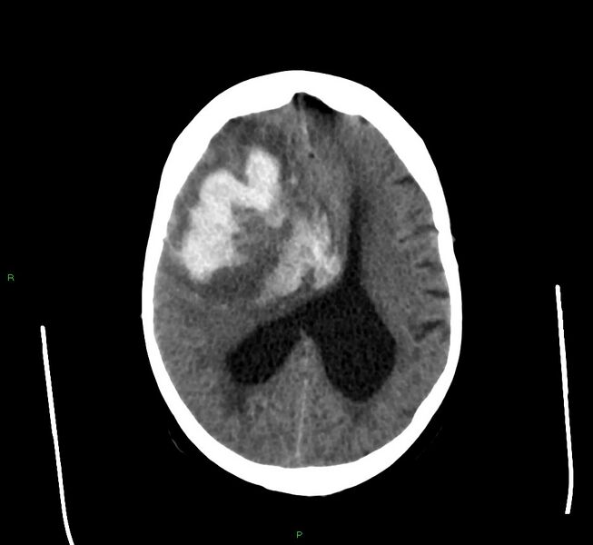 File:Cerebral amyloid angiopathy-associated lobar intracerebral hemorrhage (Radiopaedia 58560-65723 Axial non-contrast 21).jpg