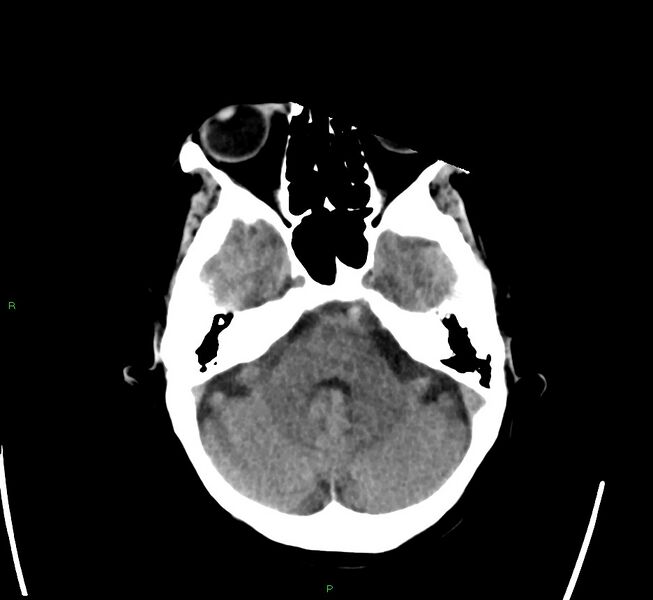 File:Cerebral amyloid angiopathy-associated lobar intracerebral hemorrhage (Radiopaedia 58563-65727 Axial non-contrast 41).jpg