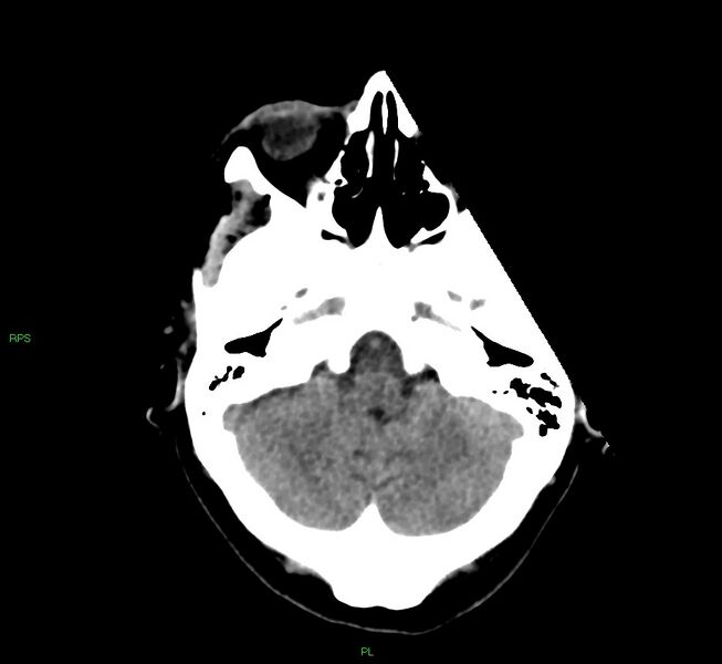 File:Cerebral amyloid angiopathy-associated lobar intracerebral hemorrhage (Radiopaedia 58569-65734 Axial non-contrast 47).jpg