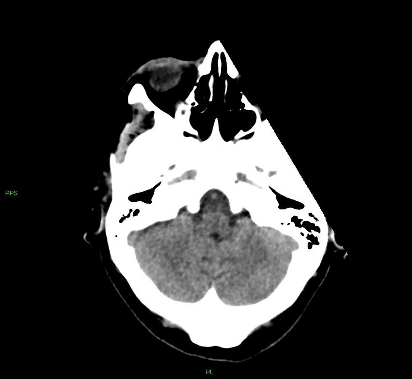 Cerebral amyloid angiopathy-associated lobar intracerebral hemorrhage (Radiopaedia 58569-65734 Axial non-contrast 47).jpg