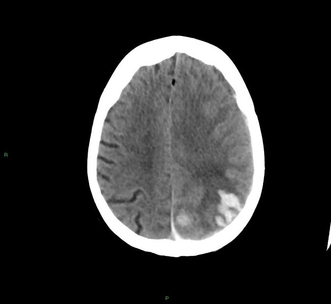 File:Cerebral amyloid angiopathy-associated lobar intracerebral hemorrhage (Radiopaedia 58754-65975 Axial non-contrast 24).jpg