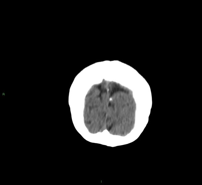 File:Cerebral amyloid angiopathy-associated lobar intracerebral hemorrhage (Radiopaedia 58757-65978 Coronal non-contrast 9).jpg