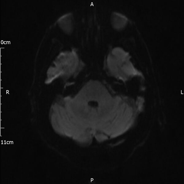 File:Cerebral amyloid angiopathy related inflammation (Radiopaedia 72772-83415 Axial DWI 30).jpg