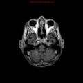 Cerebral and orbital tuberculomas (Radiopaedia 13308-13311 Axial T1 C+ 5).jpg