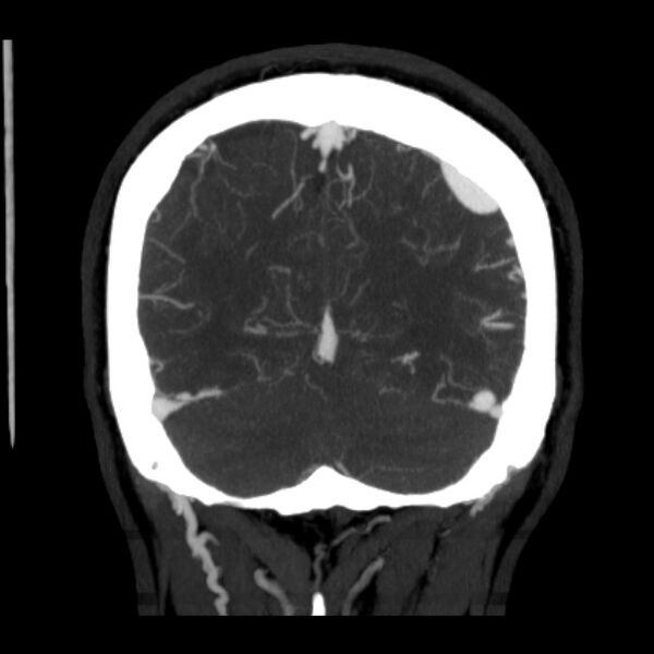 File:Cerebral arteriovenous malformation (Radiopaedia 43729-47189 C 38).jpg