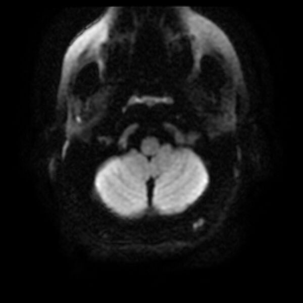 File:Cerebral cavernous malformation (Radiopaedia 44301-47942 Axial DWI 3).jpg