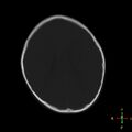 Cerebral contusion (Radiopaedia 48869-53911 Axial bone window 8).jpg