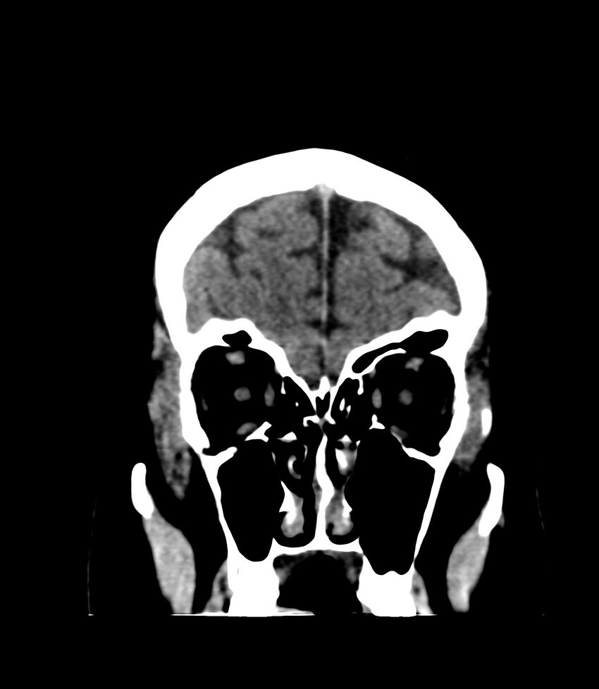 Cerebral dural venous sinus thrombosis (Radiopaedia 86514-102575 Coronal non-contrast 5).jpg