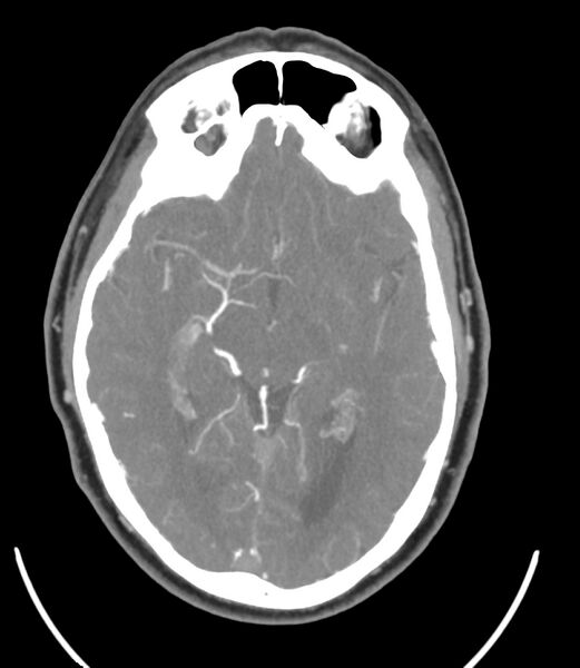 File:Cerebral dural venous sinus thrombosis (Radiopaedia 86514-102576 A 51).jpg