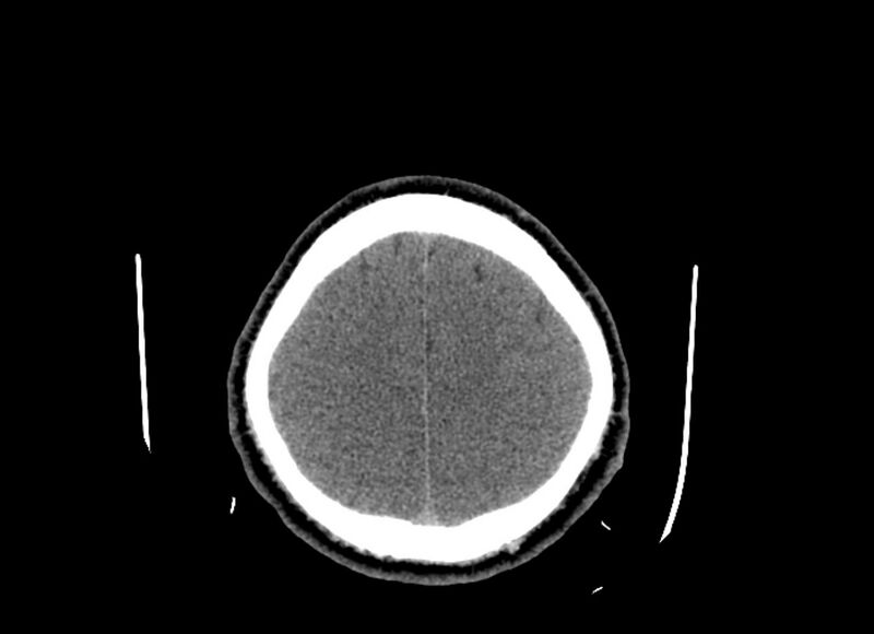 File:Cerebral edema (Radiopaedia 82519-96661 Axial non-contrast 12).jpg