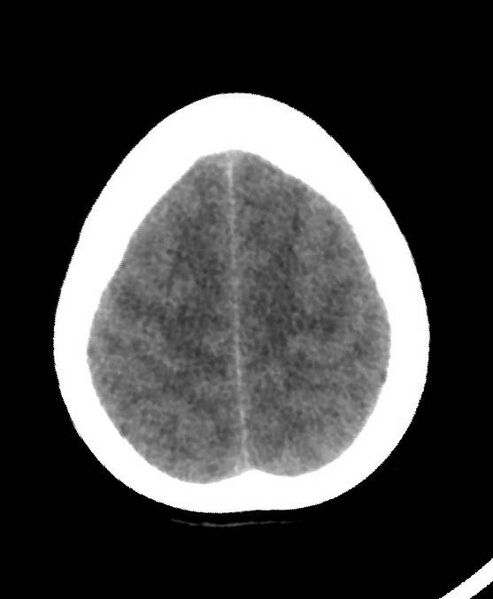 File:Cerebral edema due to severe hyponatremia (Radiopaedia 89826-106937 Axial non-contrast 78).jpg