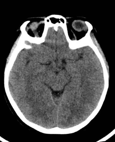 File:Cerebral edema due to severe hyponatremia (Radiopaedia 89826-106938 Axial non-contrast 45).jpg