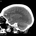 Cerebral hemorrhagic contusion with subdural and subarachnoid hemorrhage (Radiopaedia 10680-11146 C 16).jpg