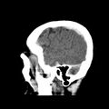 Cerebral hemorrhagic contusions (Radiopaedia 23145-23188 C 8).jpg