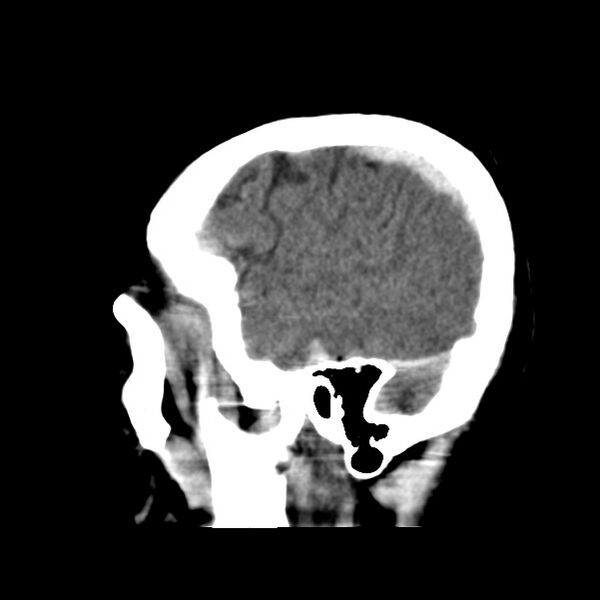 File:Cerebral hemorrhagic contusions (Radiopaedia 23145-23188 C 8).jpg